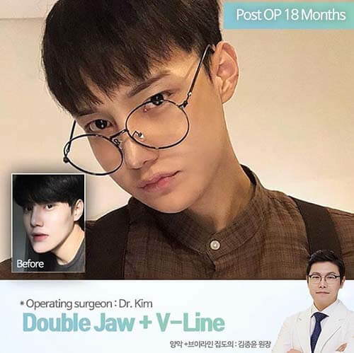 ผ่าตัดแก้ไขขากรรไกร ตัดกราม วีไลน์