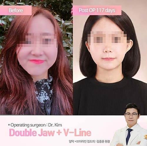 รีวิวผ่าตัดขากรรไกร เกาหลี