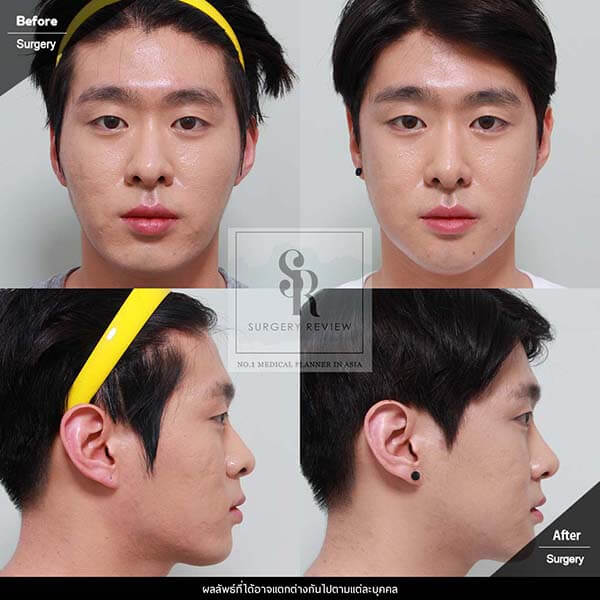 Dr Kim Nam Ho Review โหนกแก้ม และ มินิวีไลน์