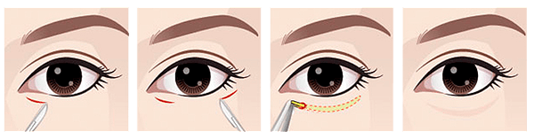 dolly-eye-ศัลยกรรม