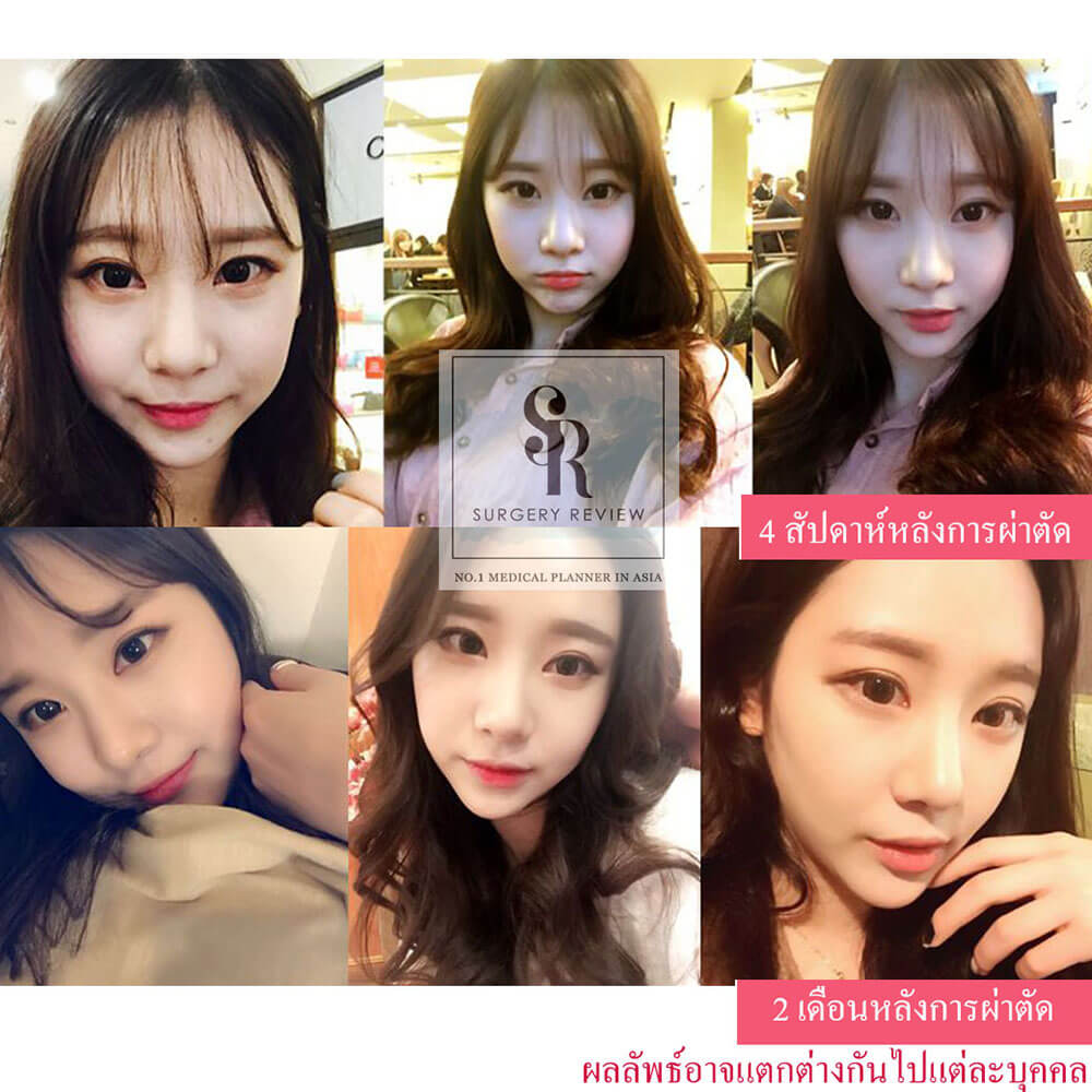 ความแตกต่าง-หลังการผ่าตัดทำศัลยกรรม