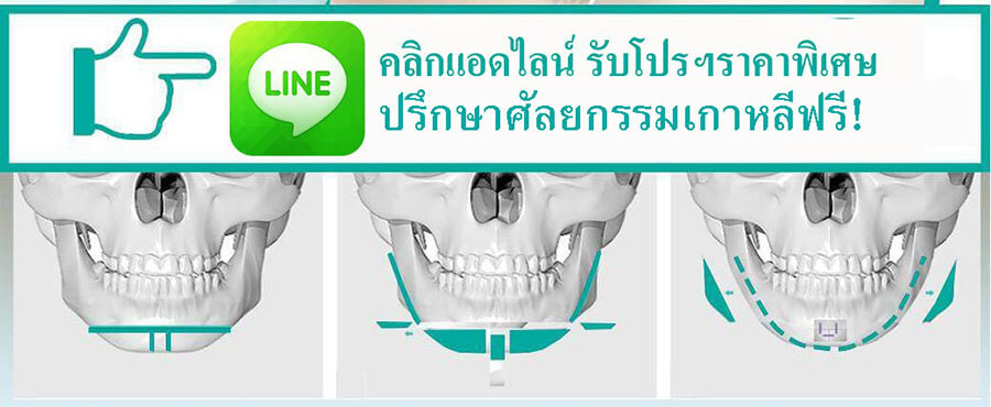 ปรึกษาศัลยกรรมเกาหลีฟรี-surgeryreview