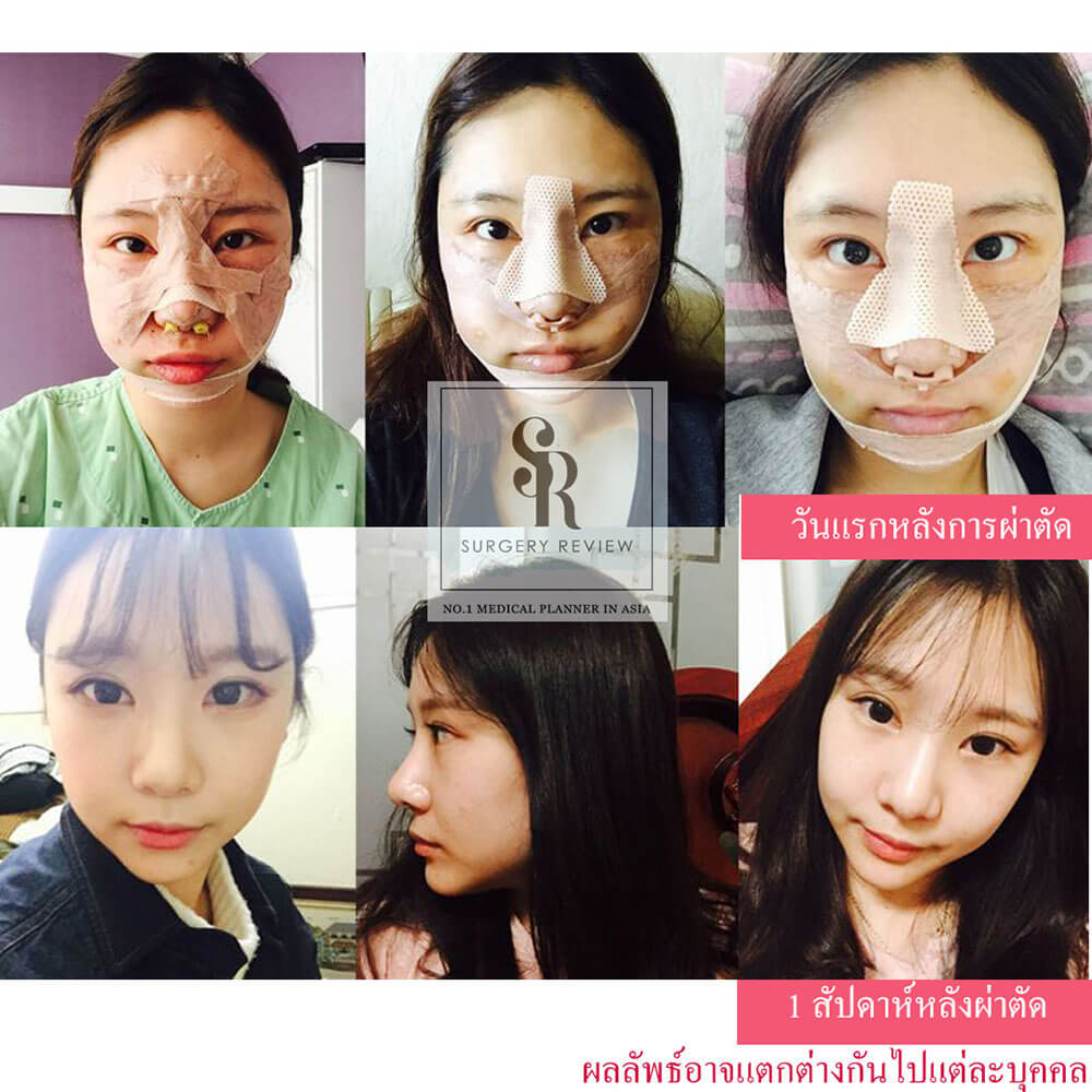 รีวิวศัลยกรรมเกาหลี-Gyalumhan-Plastic-Surgery