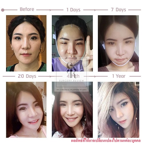 รีวิวศัลยกรรมเกาหลี-เปลี่ยนเยอะ