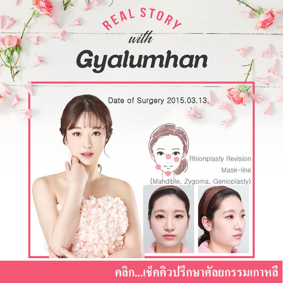 เช็คคิวปรึกษาศัลยกรรมเกาหลี