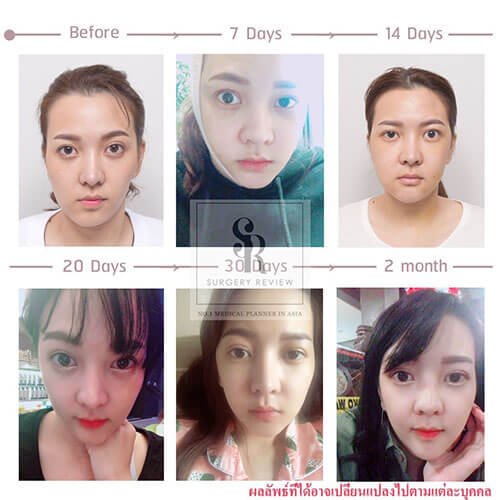รีวิวศัลยกรรมคุณทะเล แก้ไขปัญหาใบหน้า 2 ข้างไม่เท่ากัน | Surgery Review รีวิวศัลยกรรมคุณทะเล แก้ไขปัญหาใบหน้า 2 ข้างไม่เท่ากัน | Surgery Review