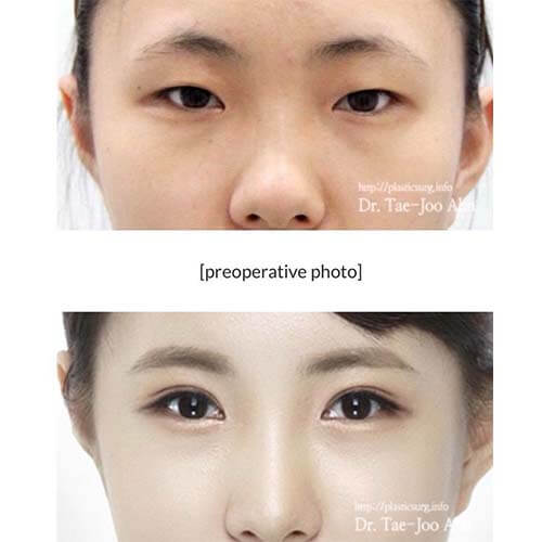 ตา2ชั้นโดยหมออัน