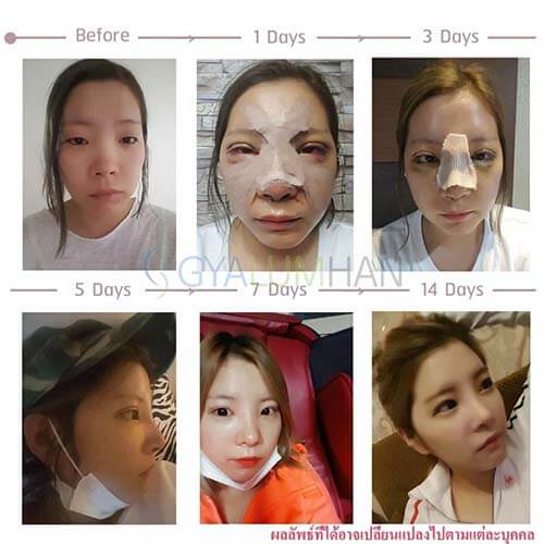 ทำตา2ชั้น Ahn Tae joo