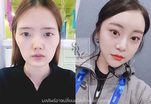 ผลงานคลินิกศัลยกรรม Gyalumhan