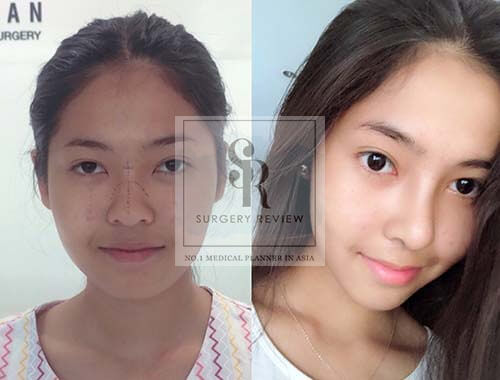 ศัลยกรรมจมูกโดย หมออัน