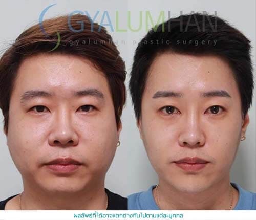 Face and Neck Liposuction