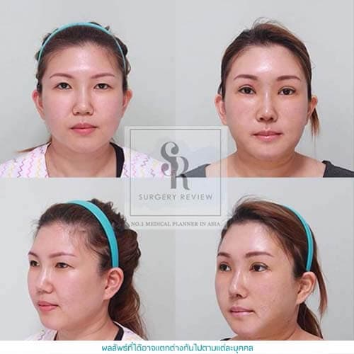 Facial Vaser Liposuction