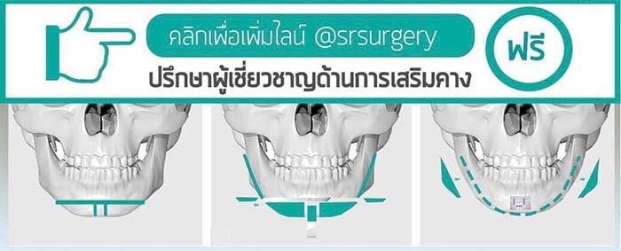 ปรึกษาผู้เชี่ยวชาญด้านการเสริมคาง