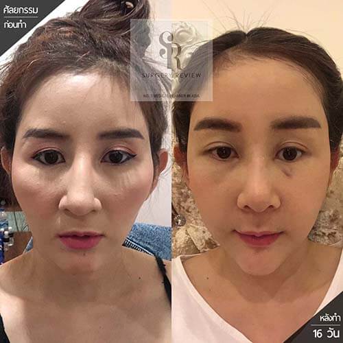 รีวิวคางสั้น