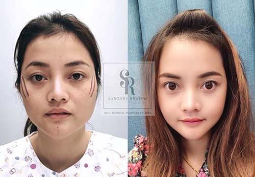 รีวิวเสริมคาง แก้ซิลิโคน