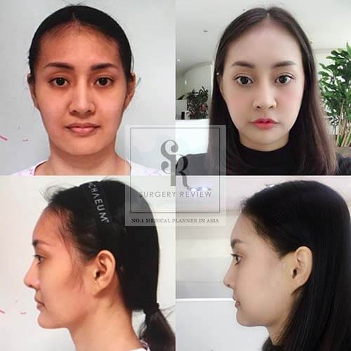 รีวิวเสริมคาง แก้ไขคางยาว