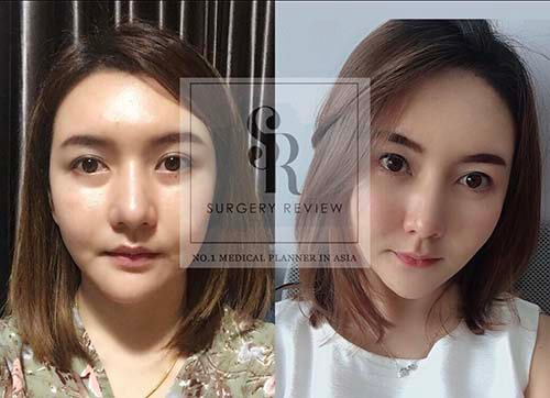 รีวิวแก้ไขคางเบี้ยว
