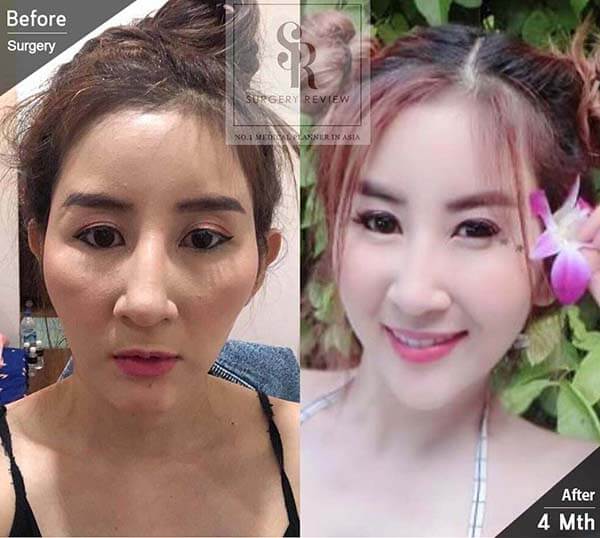 รีวิวหลังเสริมคาง 4 เดือนเข้าที่