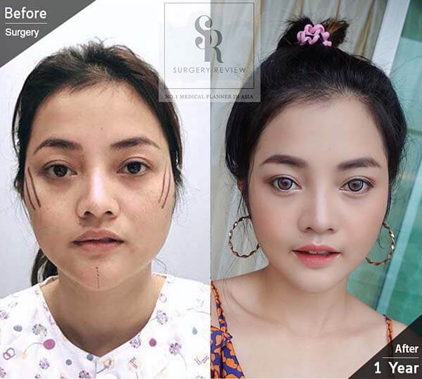 เสริมคาง 1 ปี หน้าเปลี่ยนไหม