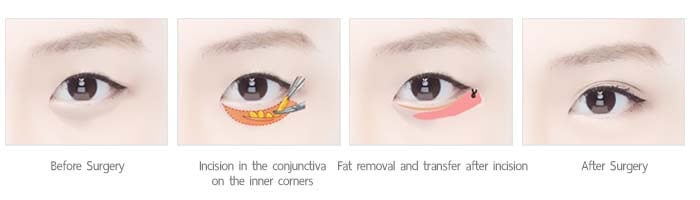 เกลี่ยไขมันใต้ตาเรียบ under eye fat removal
