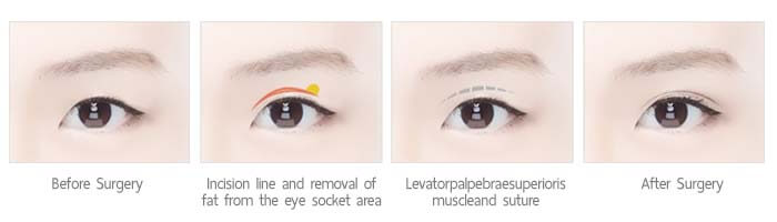 ตาสองชั้นแบบกรีด incision method