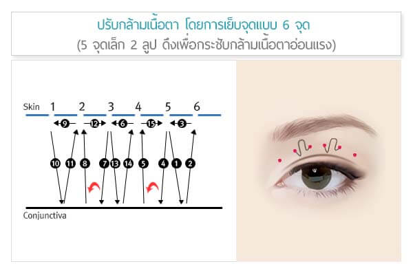 ปรับกล้ามเนื้อตา ทำตาสองชั้น