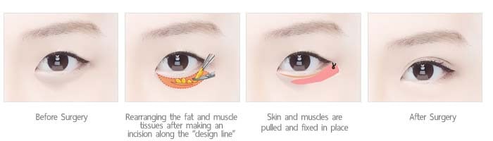 ยกกระชับใต้ตา under eye wrinkle