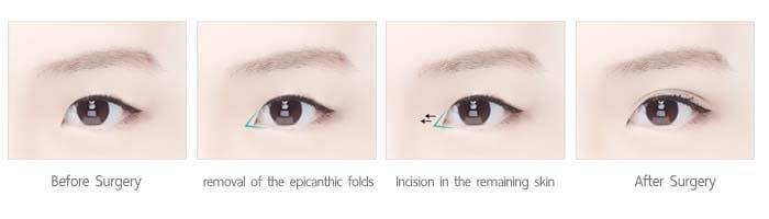 ศัลยกรรมเปิดหัวตา anterior incision