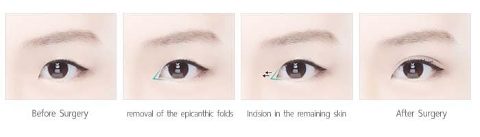 ศัลยกรรมเปิดหัวตา anterior incision