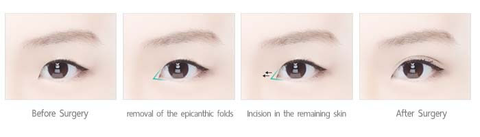 ศัลยกรรมเปิดหัวตา anterior incision