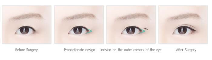 ศัลยกรรมเปิดหางตา posterior