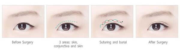 3 วิธีศัลยกรรม แก้ไขหนังตาตก วิธีไหน ผลลัพธ์ถาวร เห็นผลลัพธ์ทันทีหลังทำ |  Surgery Review