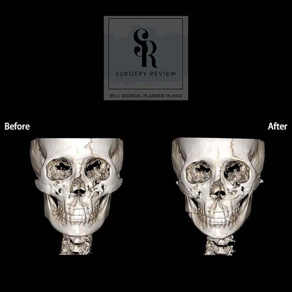 ct scan เปรียบเทียบหน้าตรง