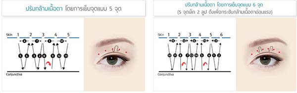 แก้หนังตาตก เย็บแบบจุด