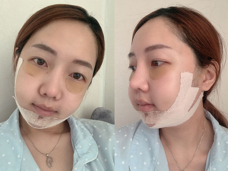 โครงหน้าดูหวานขึ้นหลังศัลยกรรม