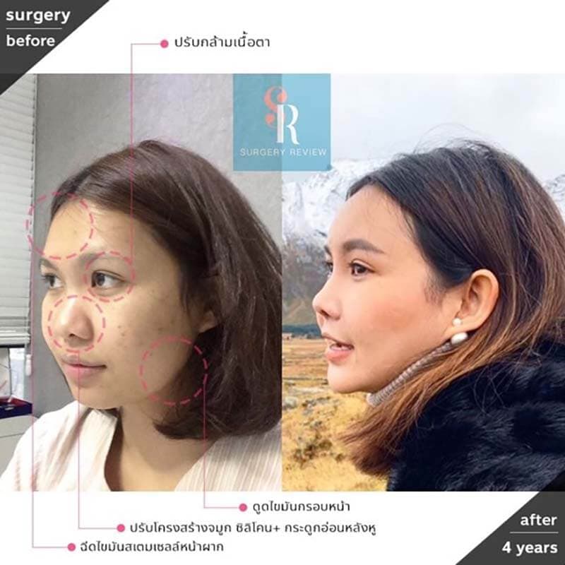 ดูดไขมันหน้า เหนียง แก้ม ใต้คาง เทคนิคหน้าเรียวได้รูปโดยไม่ต้องผ่าตัดกระดูก ดูดไขมันหน้า เหนียง แก้ม ใต้คาง เทคนิคหน้าเรียวได้รูปโดยไม่ต้องผ่าตัดกระดูก
