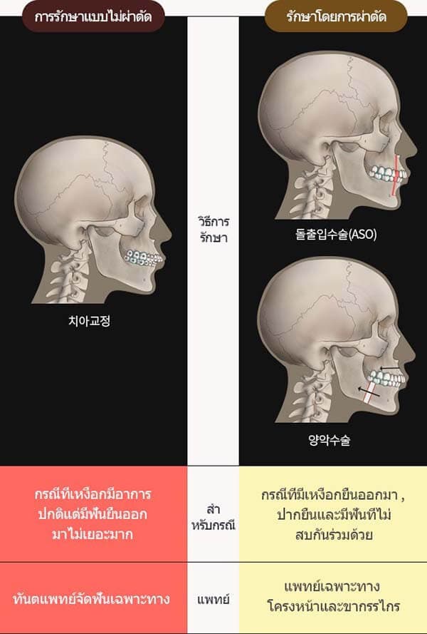 ศัลยกรรมผ่าตัด Aso แก้ไขปากยื่น คืออะไร แตกต่างจากผ่าตัดขากรรไกรอย่างไร |  Surgery Review