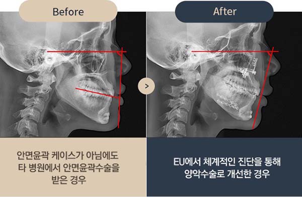 ct scan ก่อนและหลังผ่าตัดแก้ไขปากยื่น