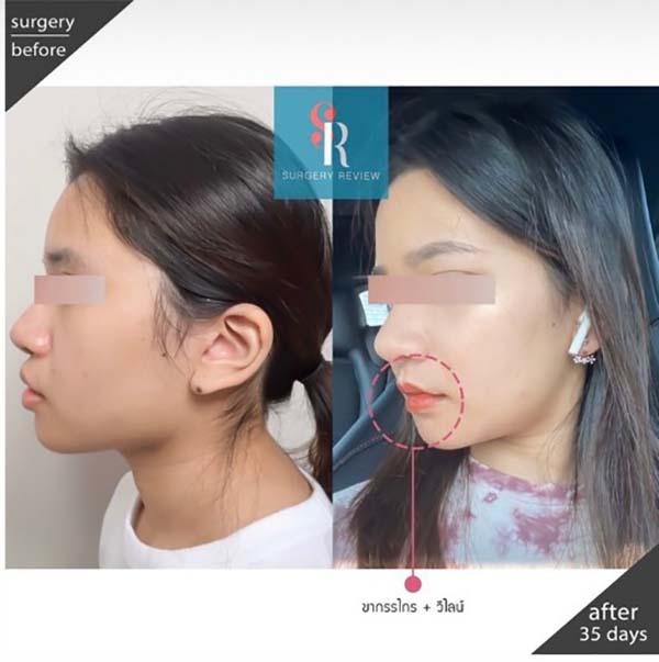 รีวิวศัลยกรรมขากรรไกร 35 วัน แก้คางยื่น กรามใหญ่ พร้อมปรับรูปหน้าให้เรียว | Surgery Review รีวิวศัลยกรรมขากรรไกร 35 วัน แก้คางยื่น กรามใหญ่ พร้อมปรับรูปหน้าให้เรียว | Surgery Review