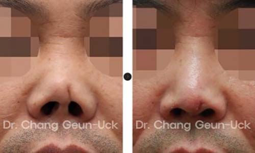 ตัวอย่างผลงานคุณหมอ Dr.Chang Guen Uck แก้ปลายจมูกมีแผลเป็น