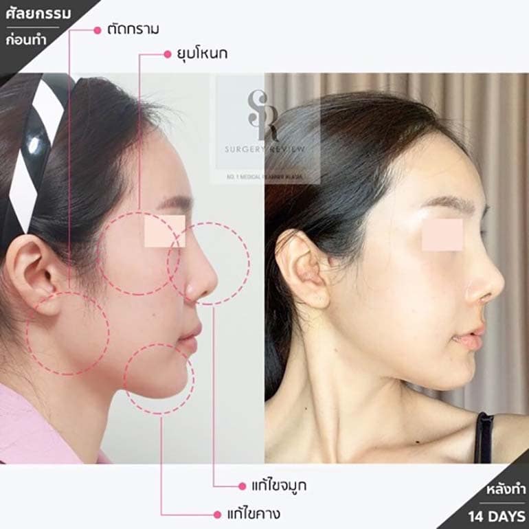 รีวิวเสริมจมูกแบบโอเพ่น กรณีที่ 2