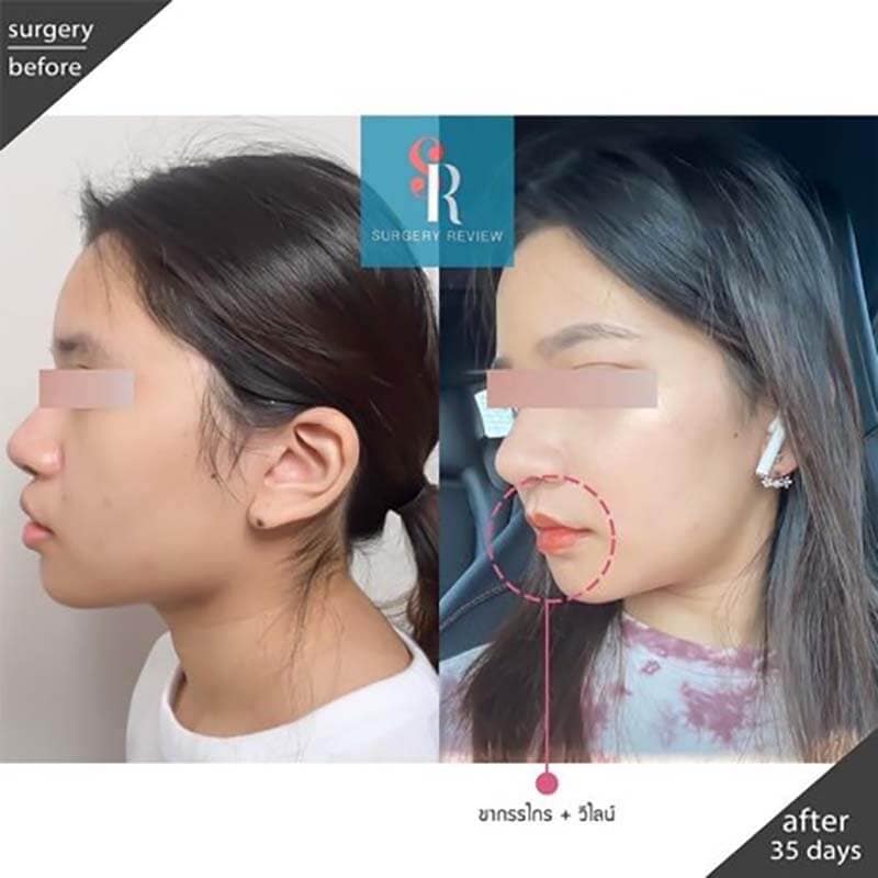 รีวิวเลื่อนตัดคางแก้คางยื่น