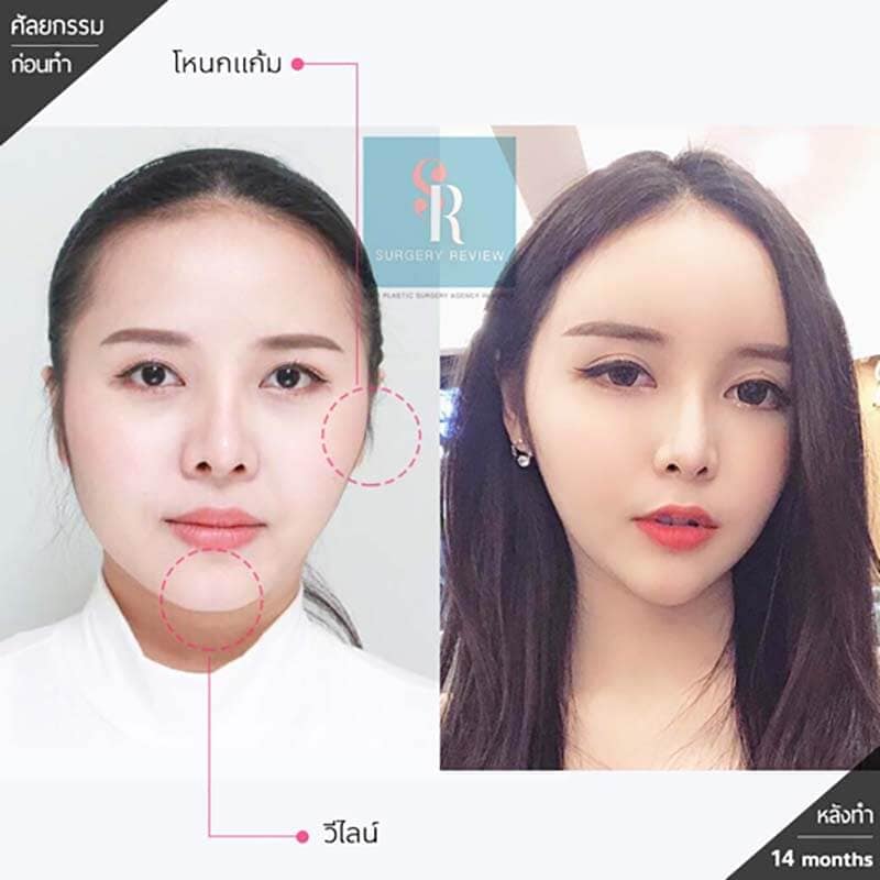 รีวิวเสริมคาง ด้วยวิธีเลื่อนคาง