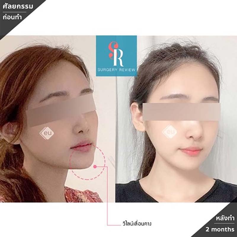 รีวิวเสริมคาง แก้คางยื่น