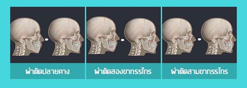 วิธีเสริมคาง ทั้ง 3 รูปแบบ