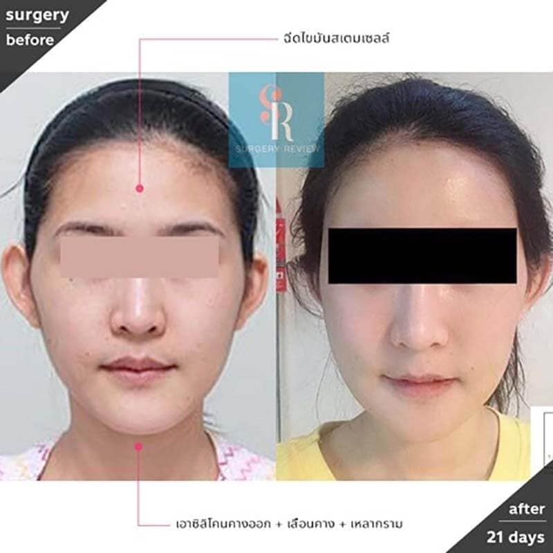เอาซิลิโคนคางออก และผ่าตัดเลื่อนคาง
