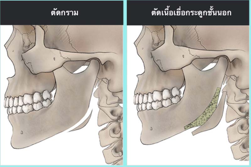 2 ขั้นตอนการผ่าตัดกราม