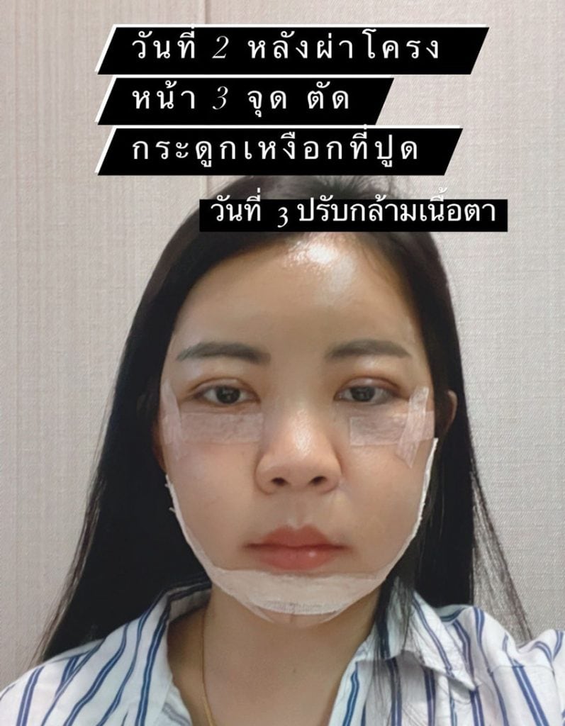 รีวิวคุณกุ๊ก ศัลยกรรมเกาหลี วันที่ 11