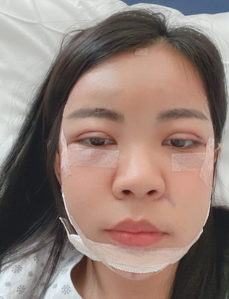 รีวิวคุณกุ๊ก ศัลยกรรมเกาหลี วันที่ 4