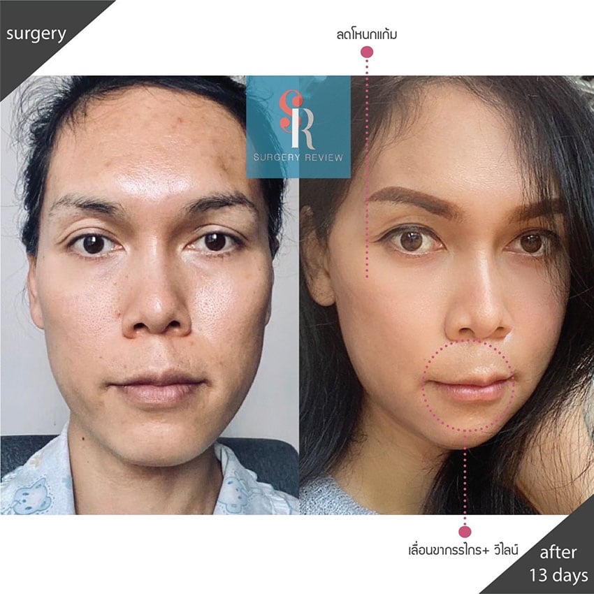 รีวิว ผ่าตัดขากรรไกร ด้านข้าง-2
